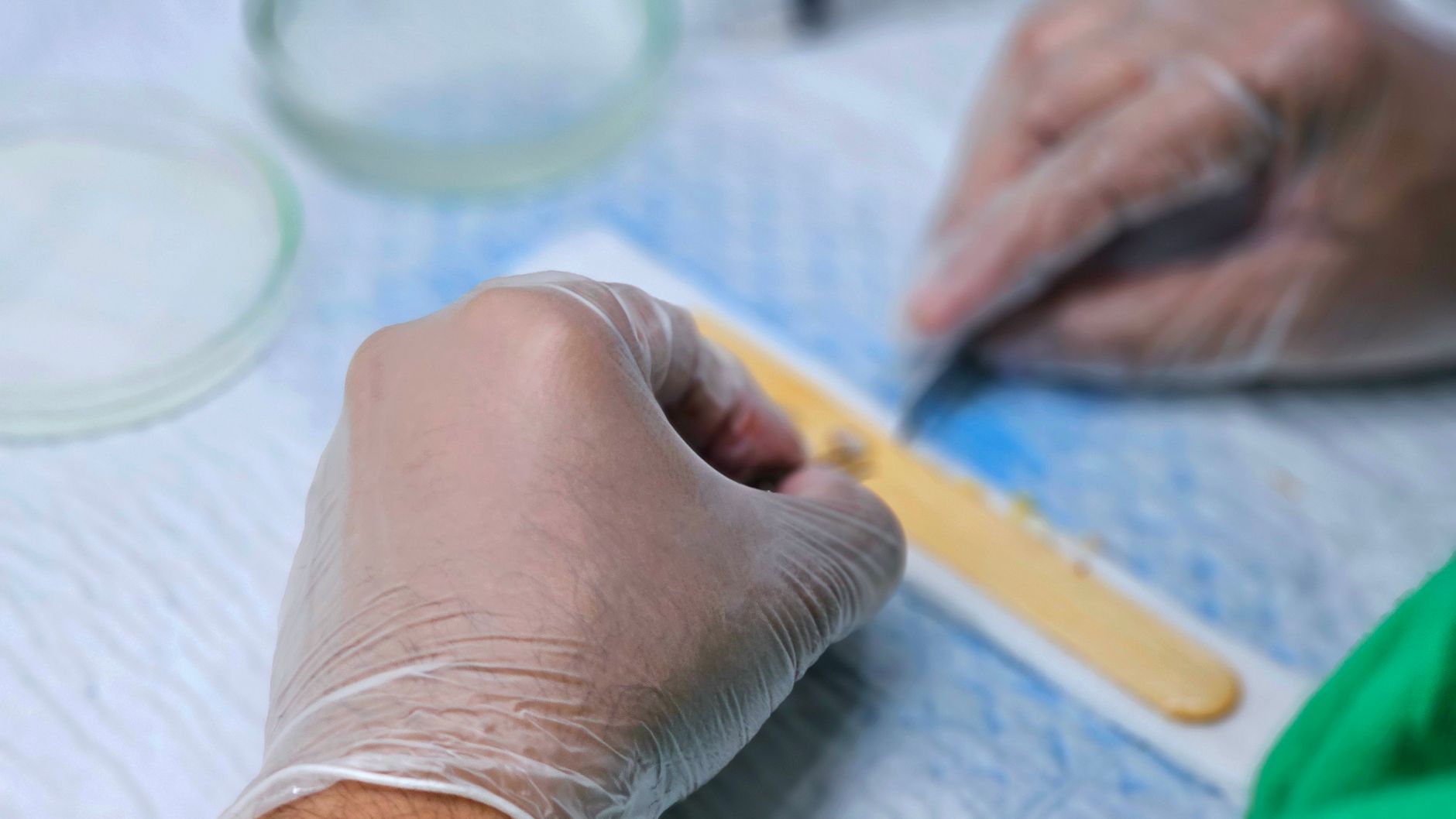 How Does Kidney Transplant Status Affect Disability Benefits?