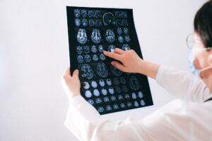 Ssdi for Epilepsy What You Need to Know - Featured image