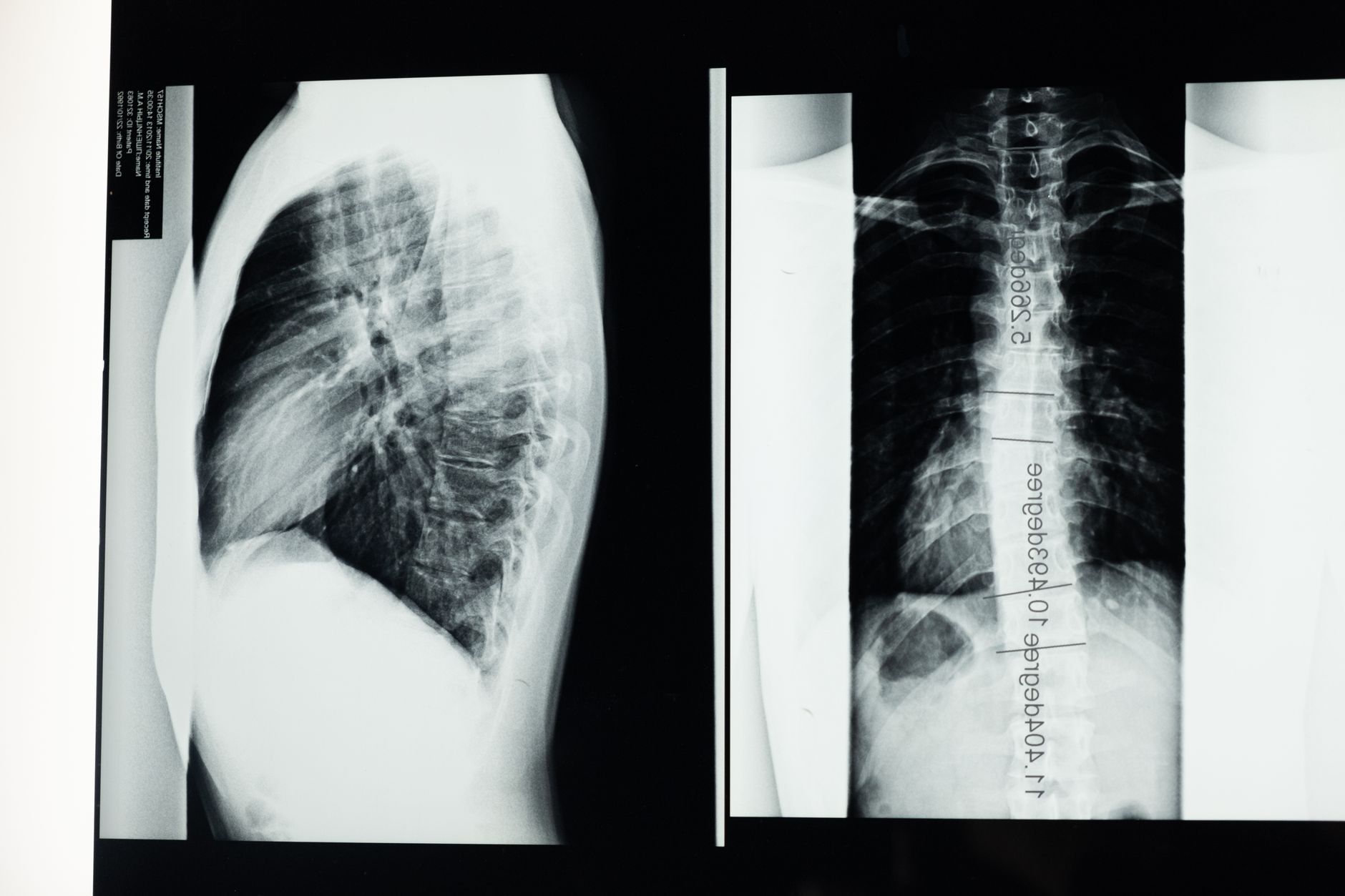 Understanding Spinal Conditions That Are More Likely to Be Approved