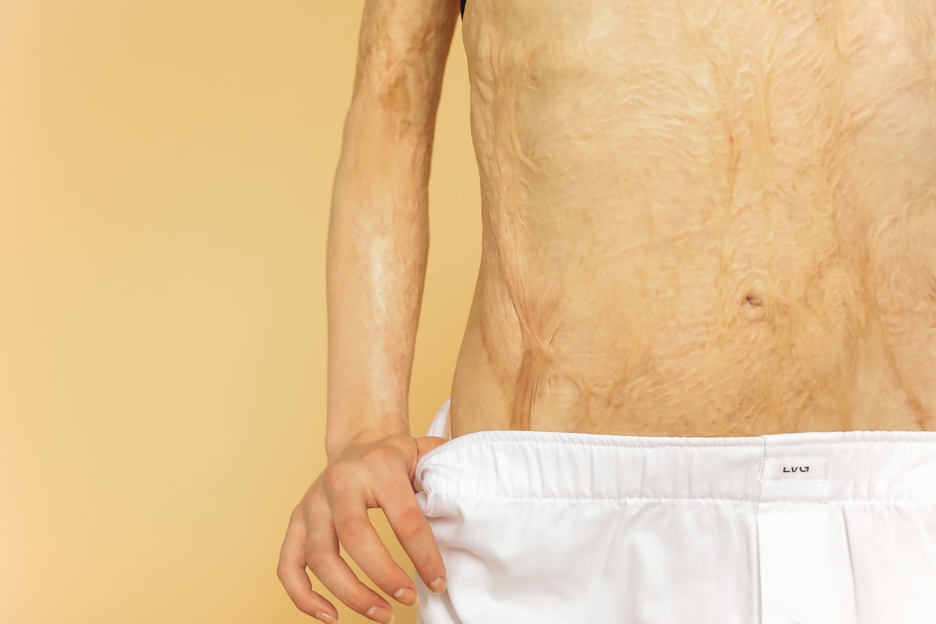 What Medical Conditions Qualify for Compassionate Allowances?