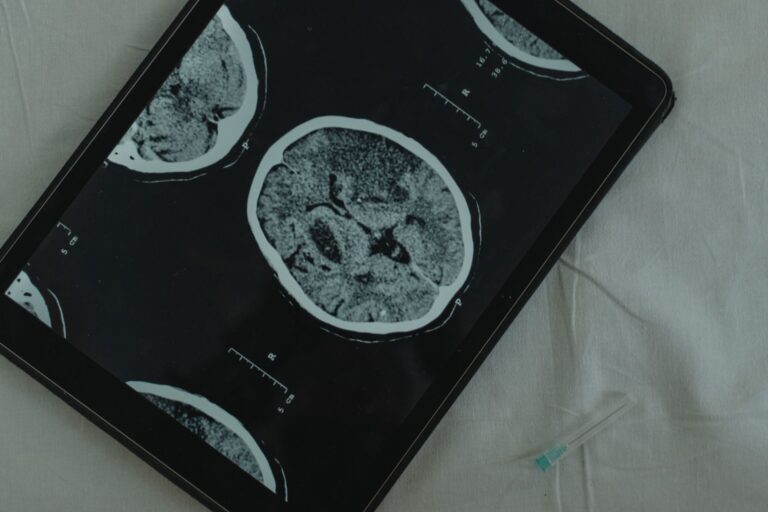 How Traumatic Brain Injury Qualifies for Disability - Featured image