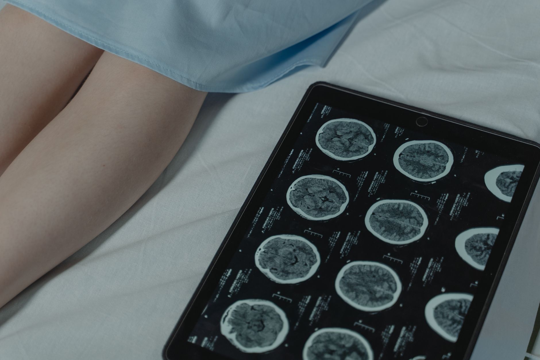 Ssdi for Traumatic Brain Injury What You Need to Know - Featured image